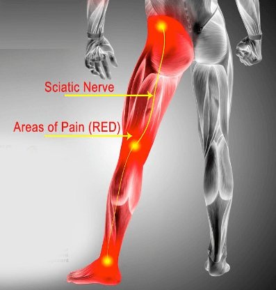 Sciatica, sciatic nerve pain